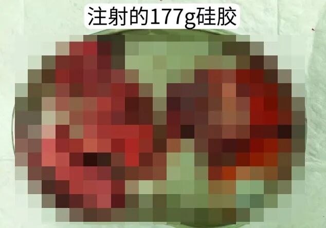 图片[2]-为求“威风”男子往“丁丁”注射177克硅胶后紧急求医！网友：受啥刺激了？-吃瓜网